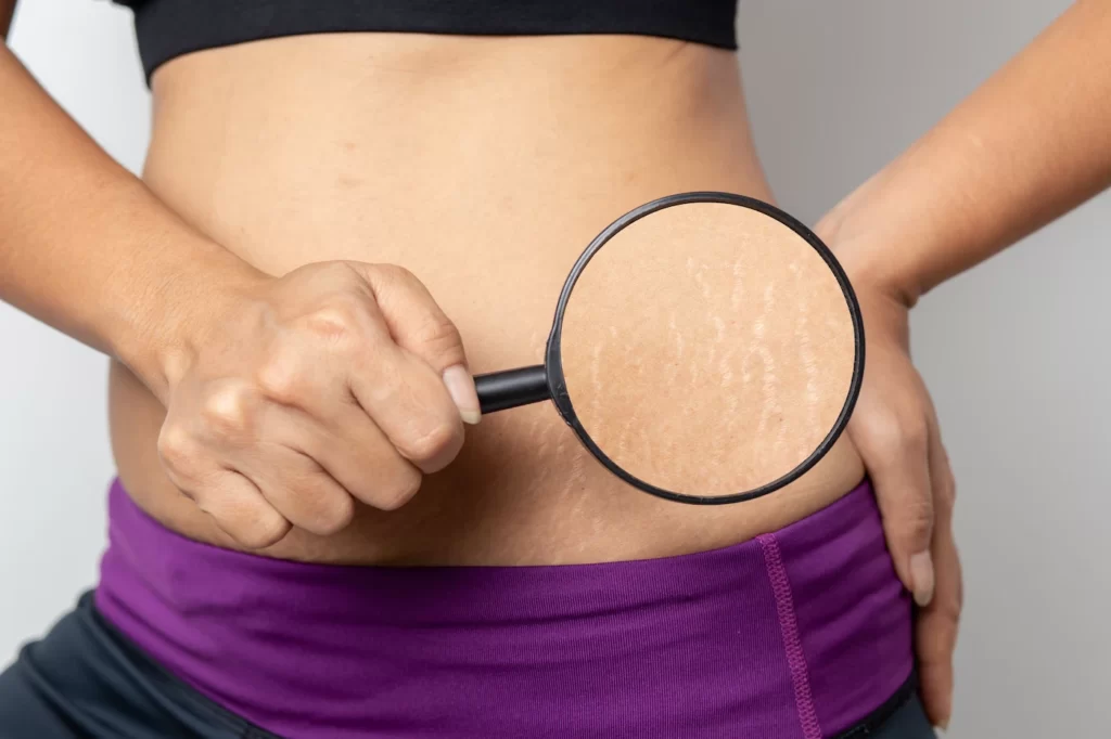 Microneedling treatment